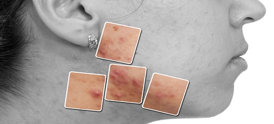 טיפול בפצעי בגרות