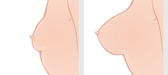 הגדלת חזה המלצות