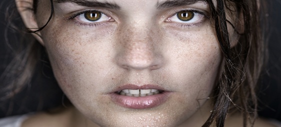 הזעת יתר בפנים