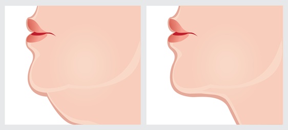 שאיבת שומן מהסנטר