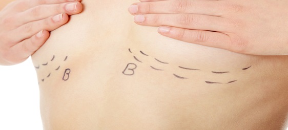 השוואה בין שתלי סיליקון לבין הגדלת חזה בהזרקה